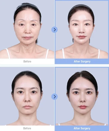 Fat Injection(Full face)